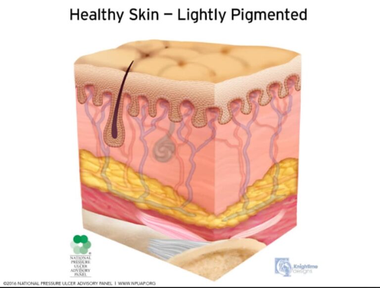 Pressure Sores Justice for Nursing Home Abuse Jeff Downey